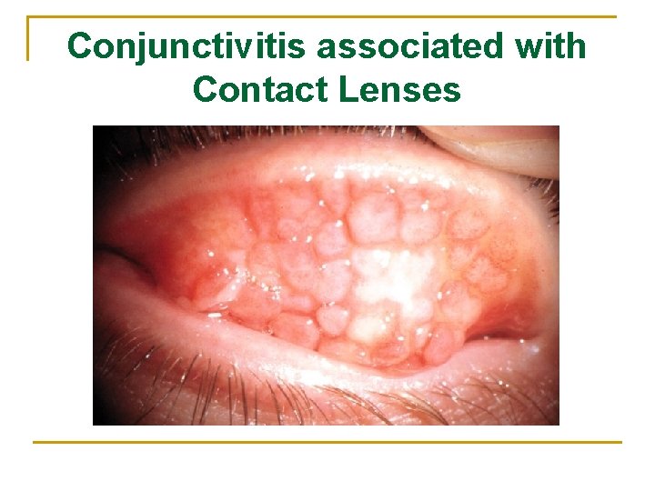 Conjunctivitis associated with Contact Lenses 