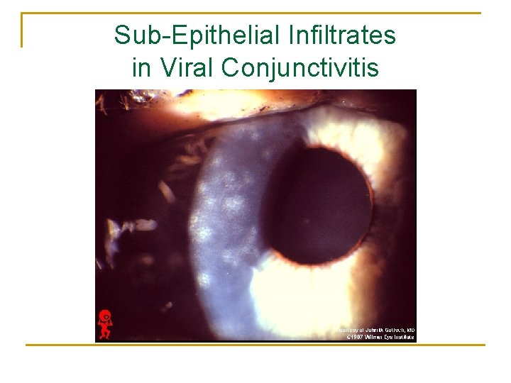 Sub-Epithelial Infiltrates in Viral Conjunctivitis 