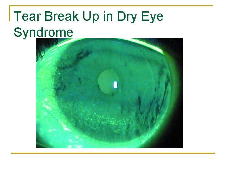 Tear Break Up in Dry Eye Syndrome 