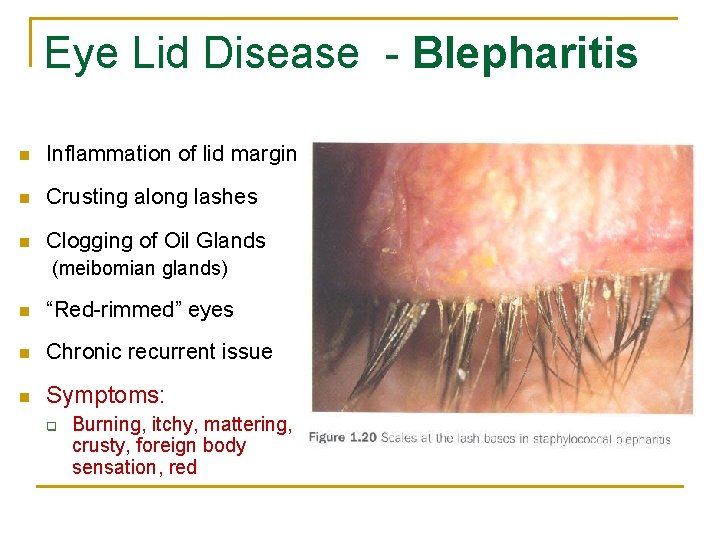 Eye Lid Disease - Blepharitis n Inflammation of lid margin n Crusting along lashes