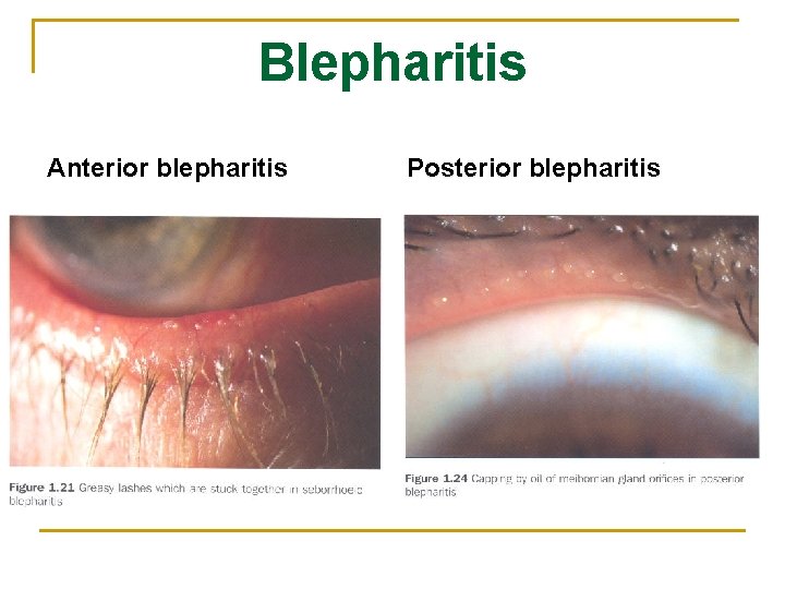 Blepharitis Anterior blepharitis Posterior blepharitis 