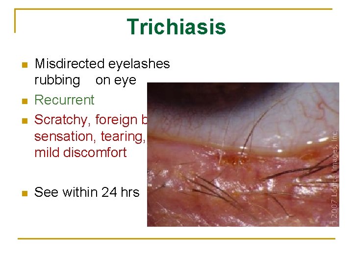 Trichiasis n n Misdirected eyelashes rubbing on eye Recurrent Scratchy, foreign body sensation, tearing,