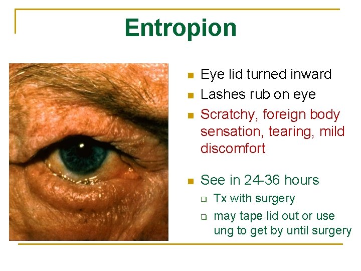 Entropion n n Eye lid turned inward Lashes rub on eye Scratchy, foreign body