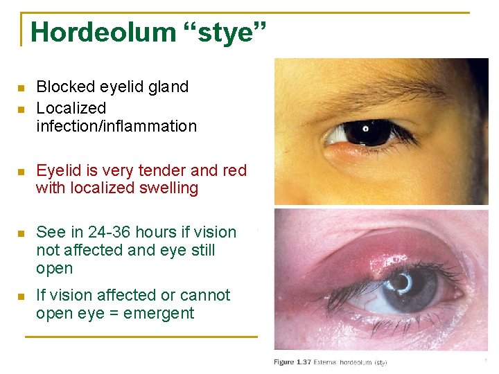 Hordeolum “stye” n n Blocked eyelid gland Localized infection/inflammation n Eyelid is very tender