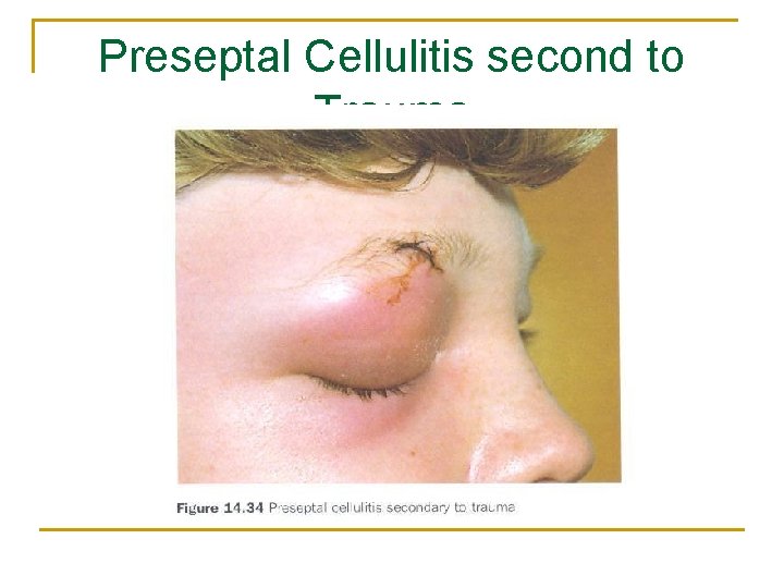 Preseptal Cellulitis second to Trauma 