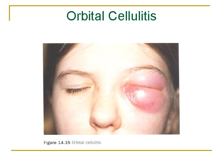 Orbital Cellulitis 