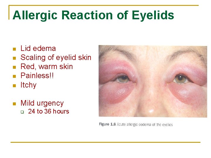Allergic Reaction of Eyelids n Lid edema Scaling of eyelid skin Red, warm skin