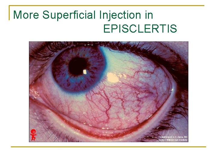 More Superficial Injection in EPISCLERTIS 