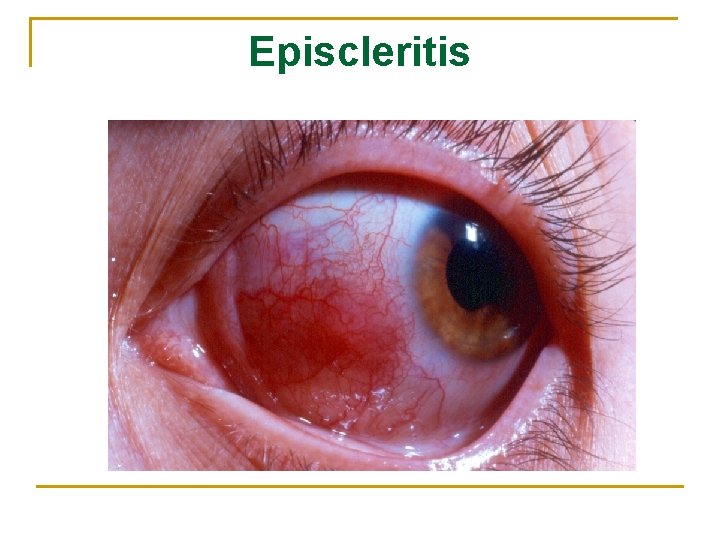 Episcleritis 