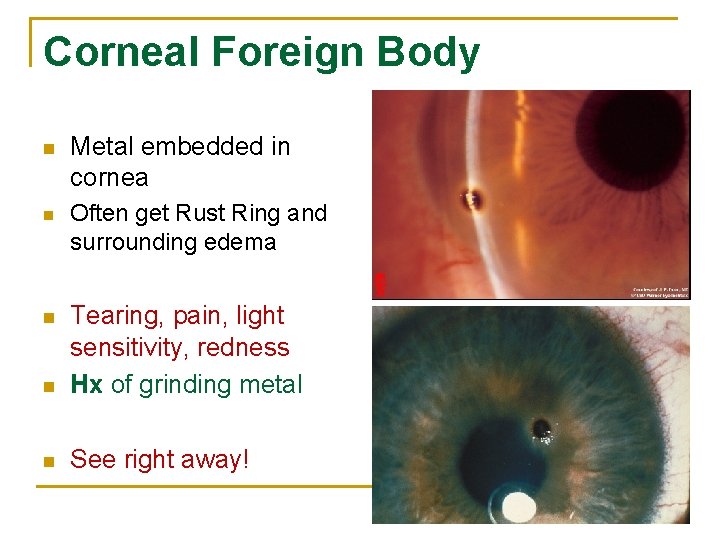 Corneal Foreign Body n Metal embedded in cornea n Often get Rust Ring and