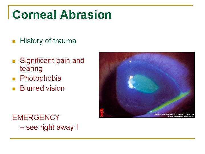 Corneal Abrasion n History of trauma n Significant pain and tearing Photophobia Blurred vision