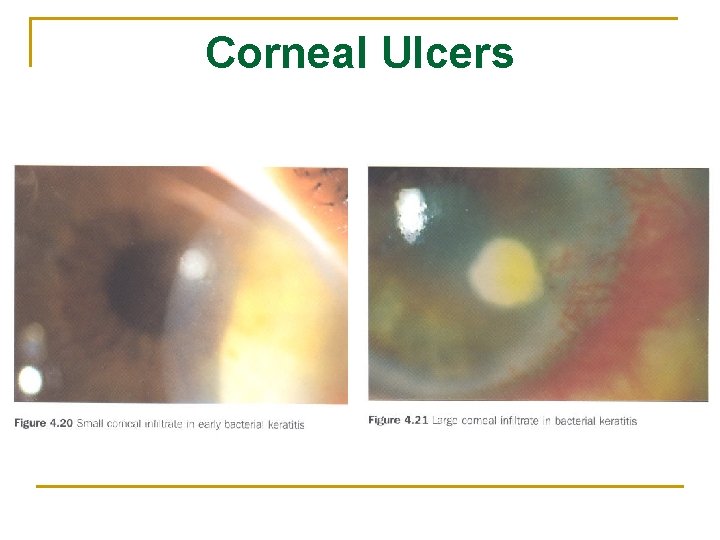 Corneal Ulcers 