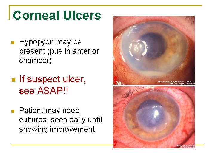 Corneal Ulcers n n n Hypopyon may be present (pus in anterior chamber) If