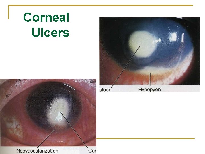 Corneal Ulcers 