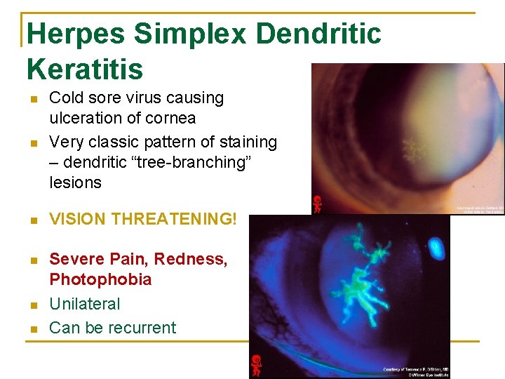 Herpes Simplex Dendritic Keratitis n Cold sore virus causing ulceration of cornea Very classic