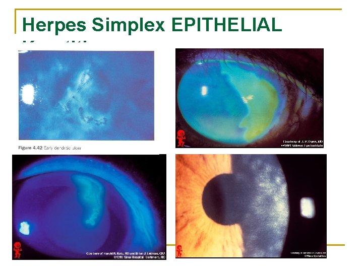 Herpes Simplex EPITHELIAL Keratitis 