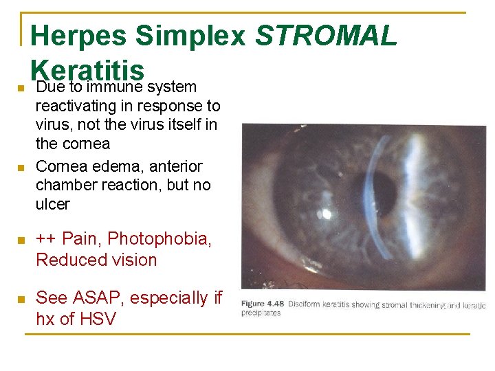 n n Herpes Simplex STROMAL Keratitis Due to immune system reactivating in response to