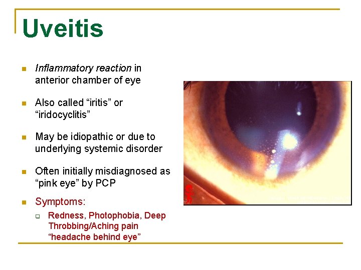 Uveitis n Inflammatory reaction in anterior chamber of eye n Also called “iritis” or