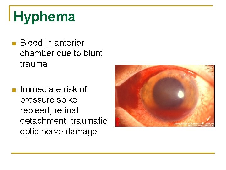 Hyphema n Blood in anterior chamber due to blunt trauma n Immediate risk of