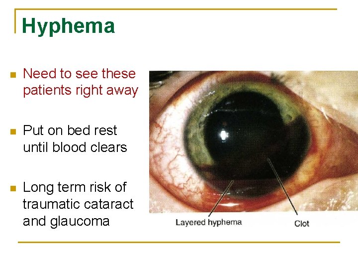 Hyphema n Need to see these patients right away n Put on bed rest