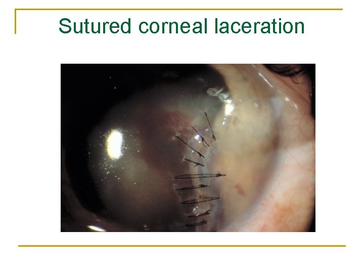 Sutured corneal laceration 