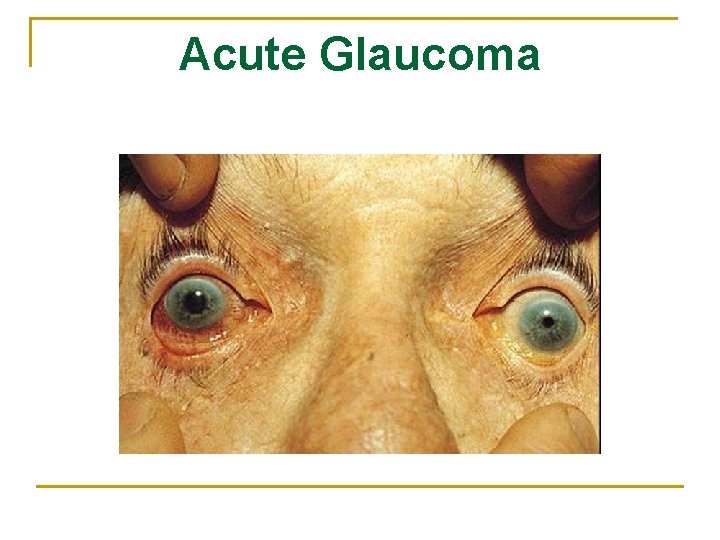 Acute Glaucoma 