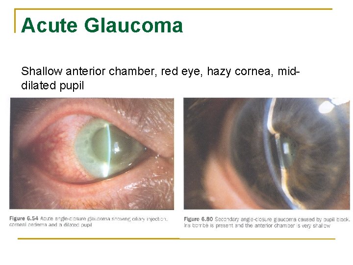 Acute Glaucoma Shallow anterior chamber, red eye, hazy cornea, middilated pupil 