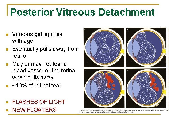 Posterior Vitreous Detachment n n n Vitreous gel liquifies with age Eventually pulls away