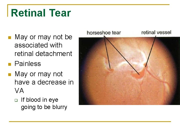 Retinal Tear n n n May or may not be associated with retinal detachment