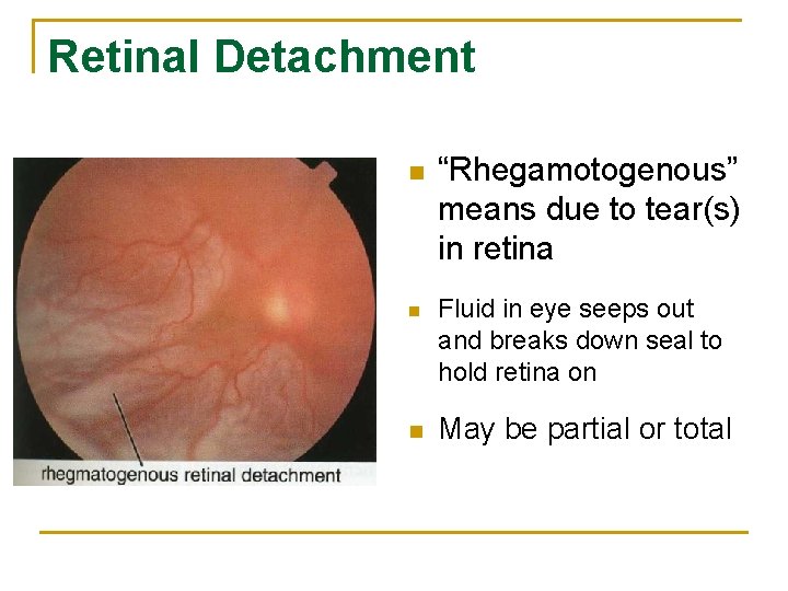 Retinal Detachment n n n “Rhegamotogenous” means due to tear(s) in retina Fluid in