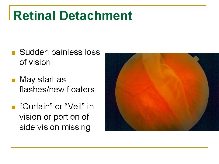 Retinal Detachment n Sudden painless loss of vision n May start as flashes/new floaters