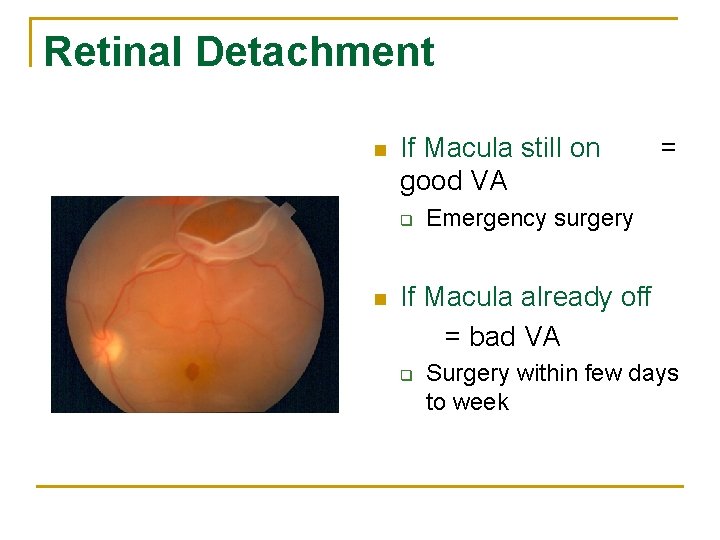 Retinal Detachment n If Macula still on good VA q n = Emergency surgery