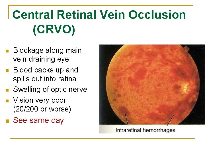 Central Retinal Vein Occlusion (CRVO) n n n Blockage along main vein draining eye