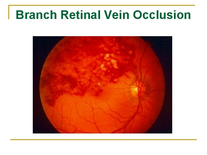 Branch Retinal Vein Occlusion 