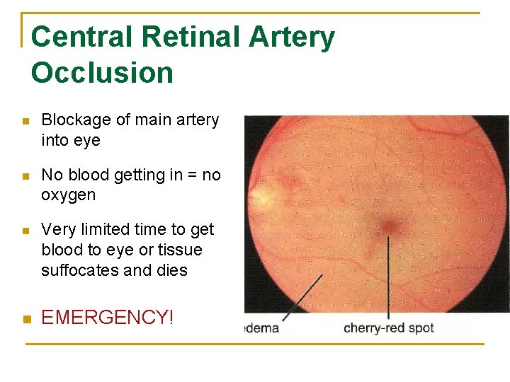 Central Retinal Artery Occlusion n Blockage of main artery into eye n No blood