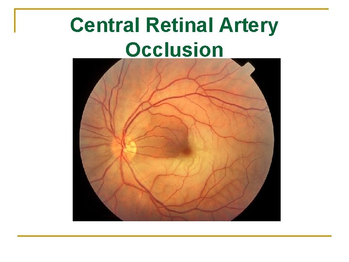 Central Retinal Artery Occlusion 