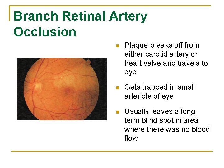 Branch Retinal Artery Occlusion n Plaque breaks off from either carotid artery or heart