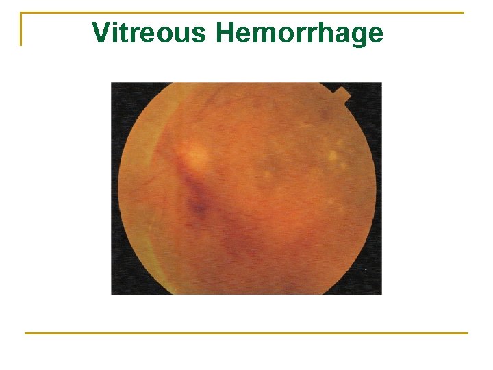 Vitreous Hemorrhage 