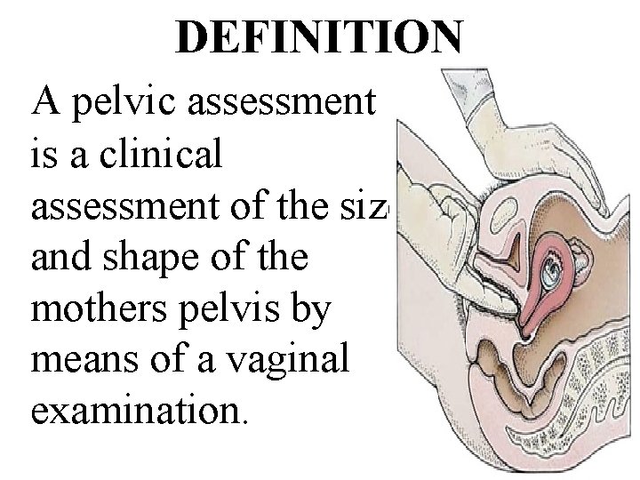 DEFINITION A pelvic assessment is a clinical assessment of the size and shape of