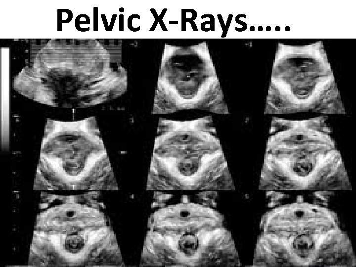 Pelvic X-Rays…. . 