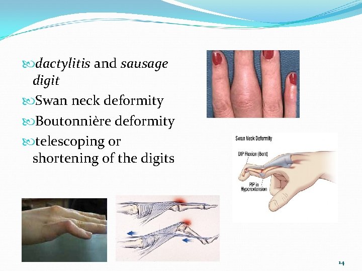 dactylitis and sausage digit Swan neck deformity Boutonnière deformity telescoping or shortening of
