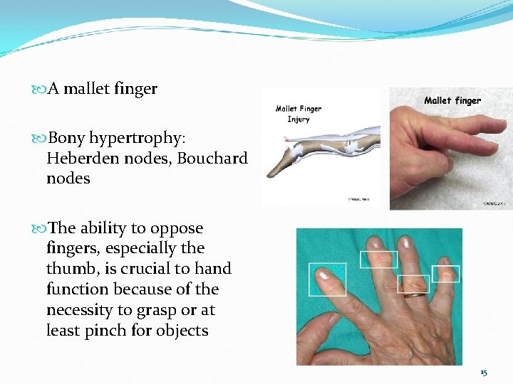  A mallet finger Bony hypertrophy: Heberden nodes, Bouchard nodes The ability to oppose