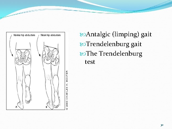  resim Antalgic (limping) gait Trendelenburg gait The Trendelenburg test 30 