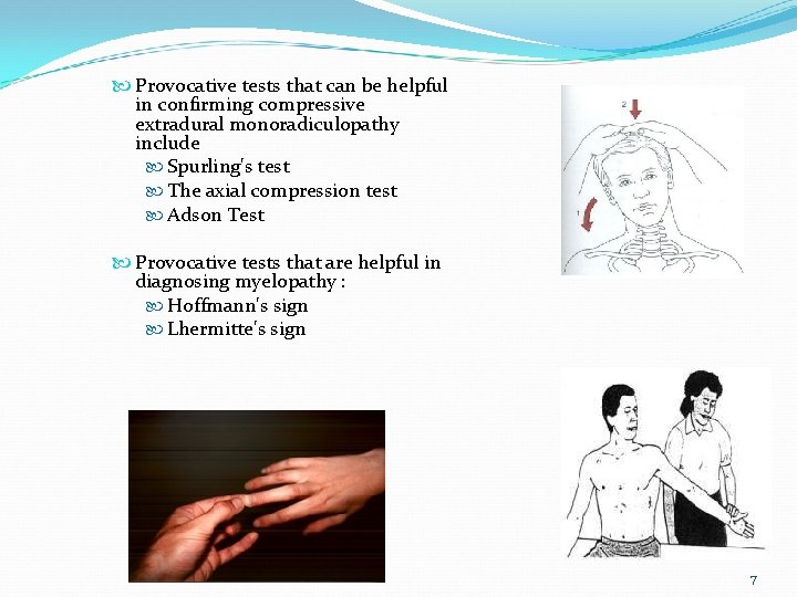  Provocative tests that can be helpful in confirming compressive extradural monoradiculopathy include Spurling's