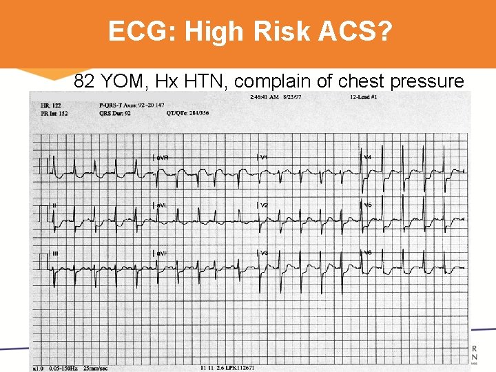 ECG: High Risk ACS? 82 YOM, Hx HTN, complain of chest pressure 3 