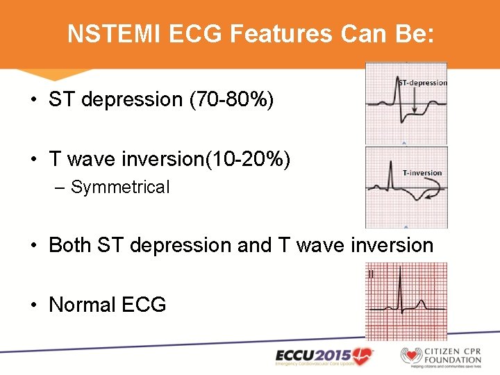NSTEMI ECG Features Can Be: • ST depression (70 -80%) • T wave inversion(10