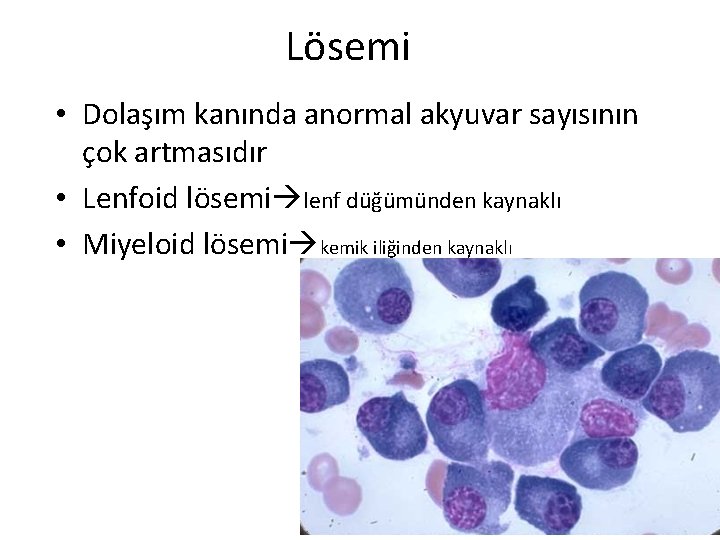 Lösemi • Dolaşım kanında anormal akyuvar sayısının çok artmasıdır • Lenfoid lösemi lenf düğümünden