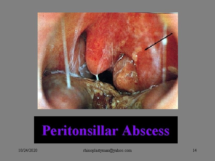 Peritonsillar Abscess 10/24/2020 rhinoplastyman@yahoo. com 14 Peritonsillar Abscess 10/24/2020 rhinoplastyman@yahoo. com 14