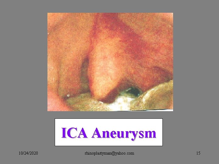 ICA Aneurysm 10/24/2020 rhinoplastyman@yahoo. com 15 ICA Aneurysm 10/24/2020 rhinoplastyman@yahoo. com 15