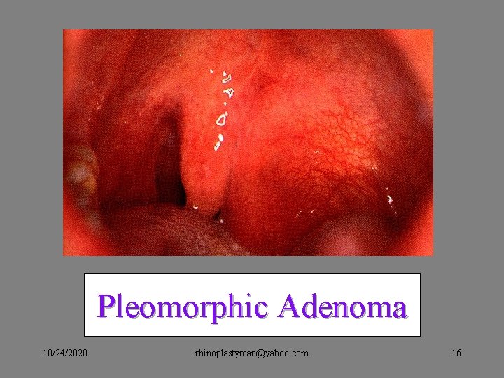 Pleomorphic Adenoma 10/24/2020 rhinoplastyman@yahoo. com 16 Pleomorphic Adenoma 10/24/2020 rhinoplastyman@yahoo. com 16